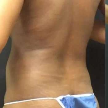 Smartlipo Vaser Lipo Before & After Patient #445