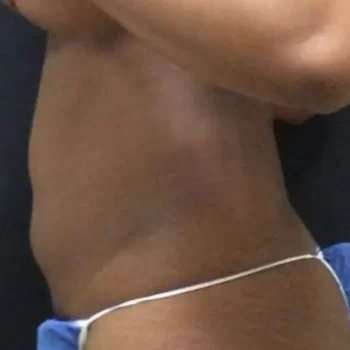 Smartlipo Vaser Lipo Before & After Patient #445