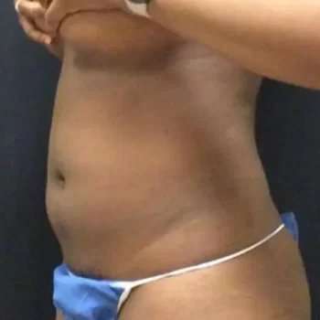 Smartlipo Vaser Lipo Before & After Patient #445