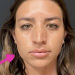 Botox Before & After Patient #698