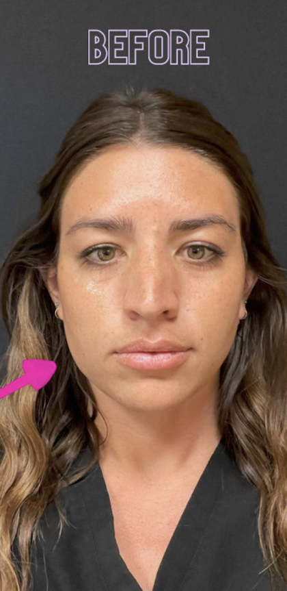 Botox Before & After Patient #698