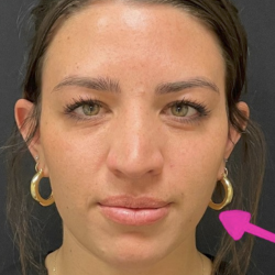 Botox Before & After Patient #698