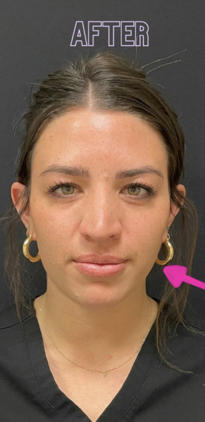 Botox Before & After Patient #698