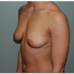 Breast Augmentation Before & After Patient #206