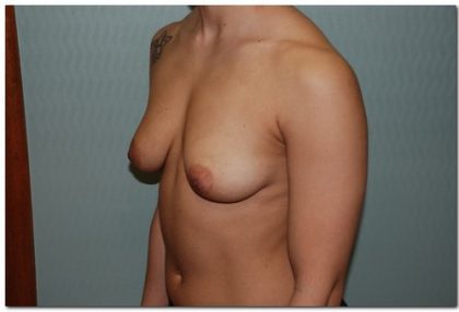 Breast Augmentation Before & After Patient #206