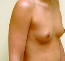 Breast Augmentation Before & After Patient #221
