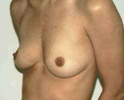 Breast Augmentation Before & After Patient #227