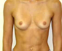 Breast Augmentation Before & After Patient #224