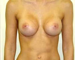 Breast Augmentation Before & After Patient #224