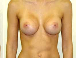 Breast Augmentation Before & After Patient #224