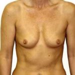 Breast Augmentation Before & After Patient #218