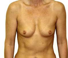 Breast Augmentation Before & After Patient #218