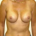 Breast Augmentation Before & After Patient #218