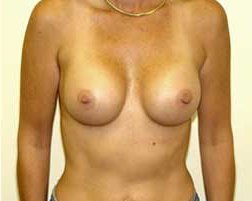 Breast Augmentation Before & After Patient #218