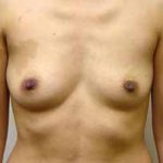 Breast Augmentation Before & After Patient #215