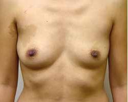 Breast Augmentation Before & After Patient #215