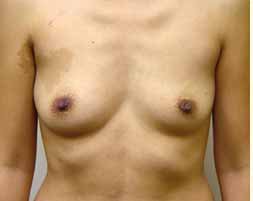 Breast Augmentation Before & After Patient #215