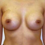 Breast Augmentation Before & After Patient #215
