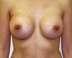 Breast Augmentation Before & After Patient #215