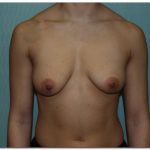 Breast Augmentation Before & After Patient #203