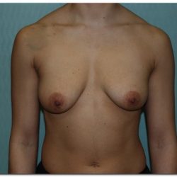 Breast Augmentation Before & After Patient #203