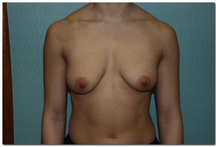 Breast Augmentation Before & After Patient #203