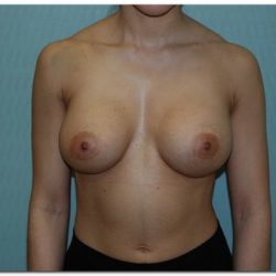 Breast Augmentation Before & After Patient #203