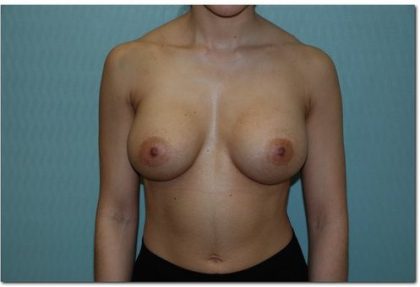 Breast Augmentation Before & After Patient #203