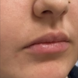 Filler Before & After Patient #734