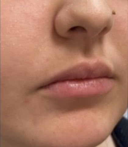 Filler Before & After Patient #734