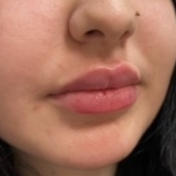 Filler Before & After Patient #734
