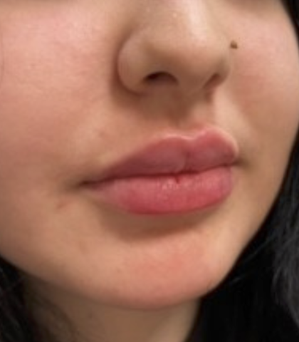 Filler Before & After Patient #734