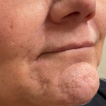 Filler Before & After Patient #731