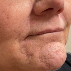 Filler Before & After Patient #731