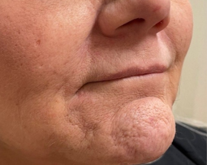 Filler Before & After Patient #731