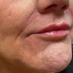 Filler Before & After Patient #731