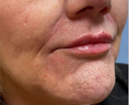 Filler Before & After Patient #731