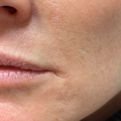 Filler Before & After Patient #737