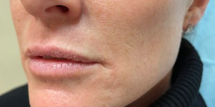 Filler Before & After Patient #737