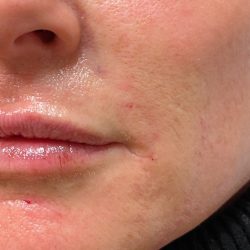 Filler Before & After Patient #737