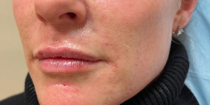 Filler Before & After Patient #737