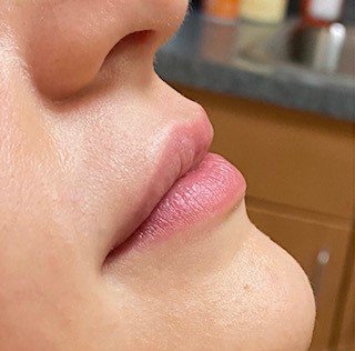 Filler Before & After Patient #752