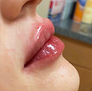Filler Before & After Patient #752