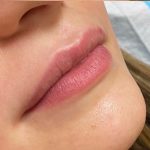 Filler Before & After Patient #752