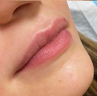 Filler Before & After Patient #752