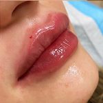 Filler Before & After Patient #752