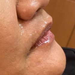 Filler Before & After Patient #747