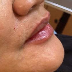 Filler Before & After Patient #747