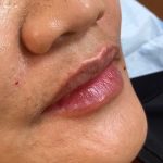 Filler Before & After Patient #747