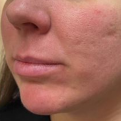Filler Before & After Patient #742